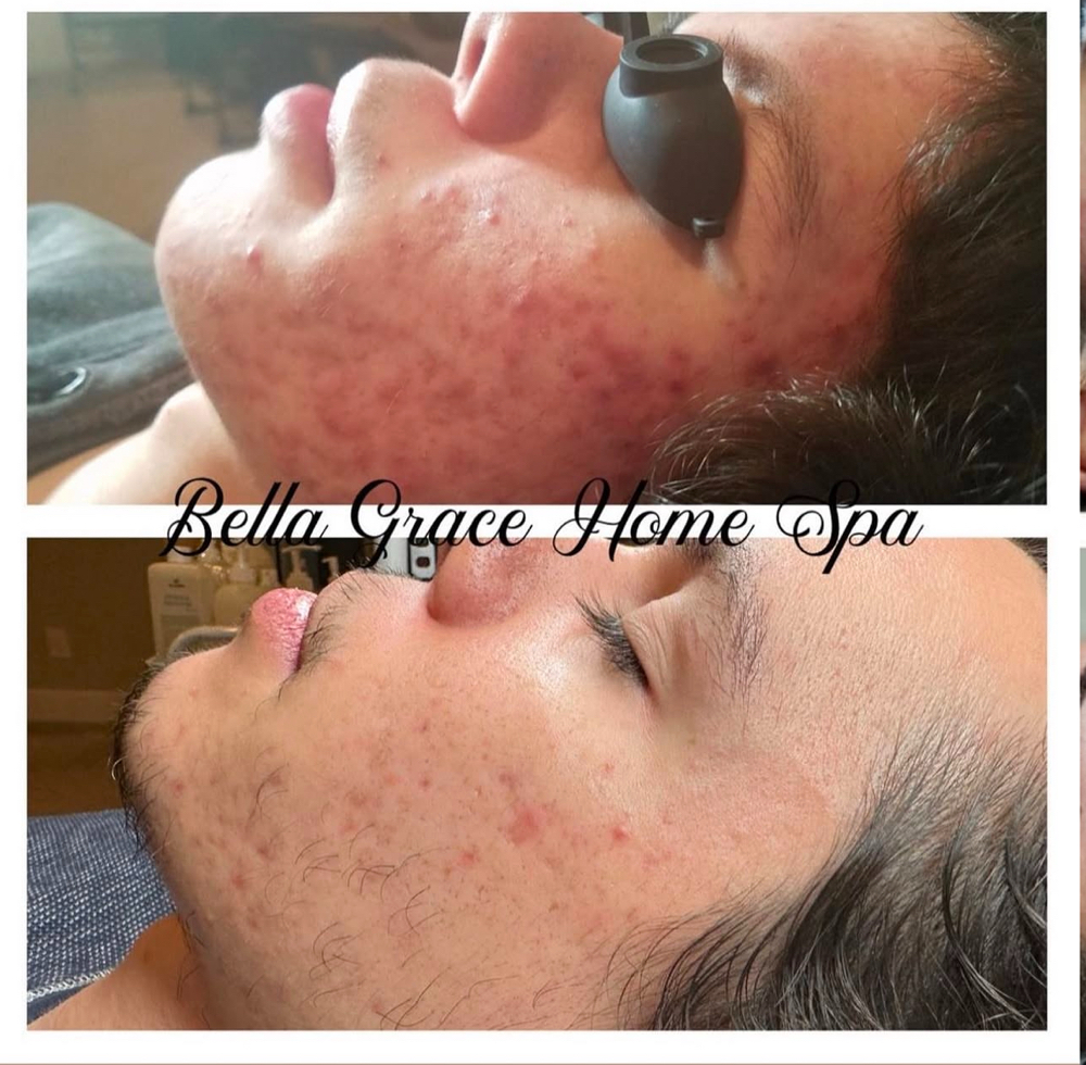 Acne Facial Treatment