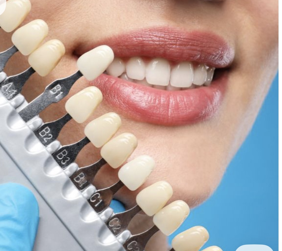Teeth Whitening
