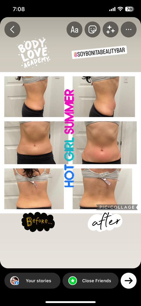 Body Contouring