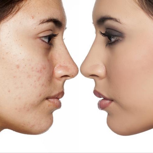 The Reset Facial (acne skin)