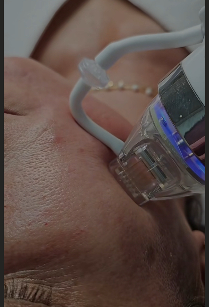 Microagulhamento Robotico at Jessica Luchesi Skin Wellness in Elizabeth, NJ