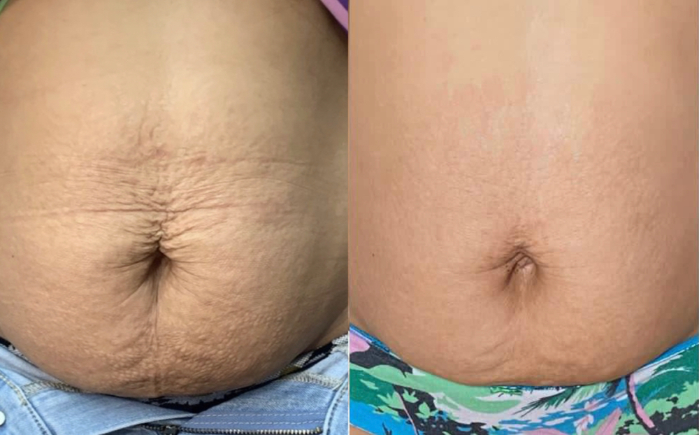 Fibroplasma at PRIVÉ in Carolina, PR