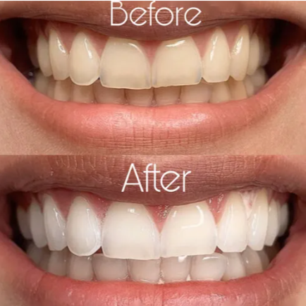 Teeth whitening