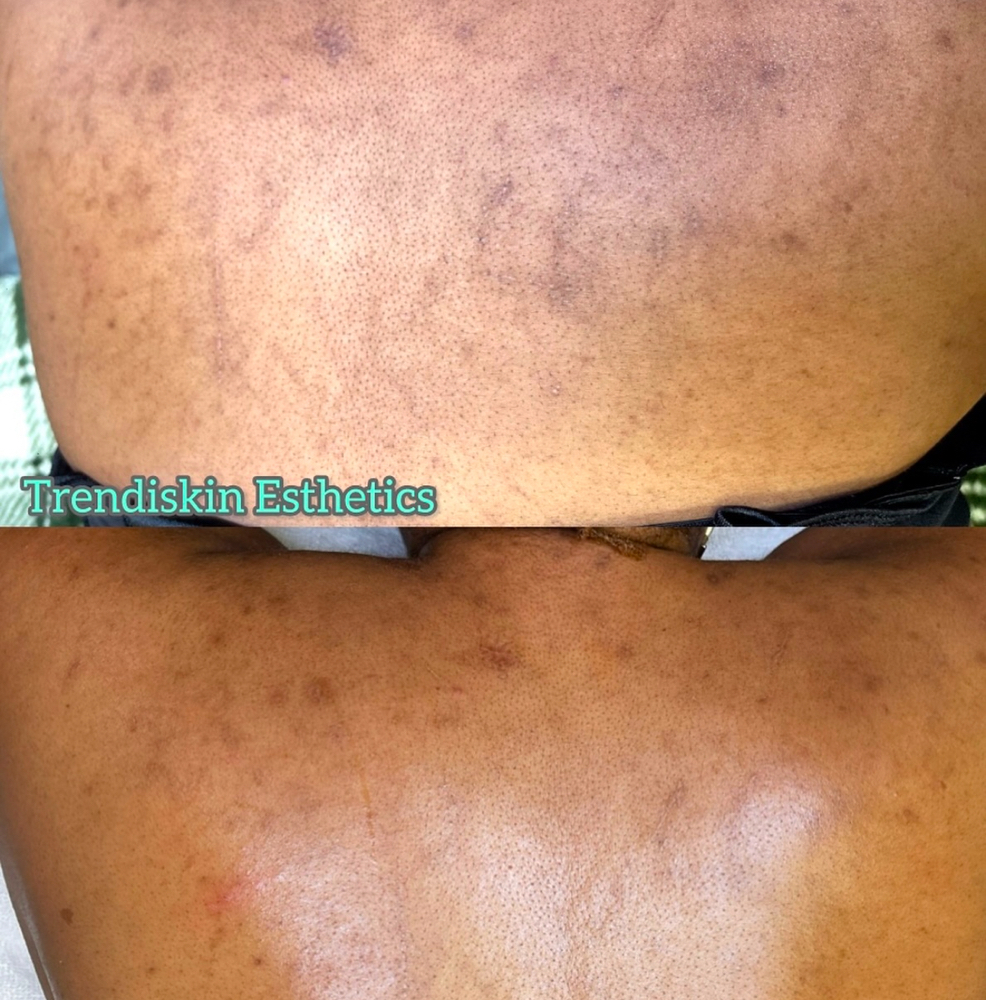 Back Treatment
