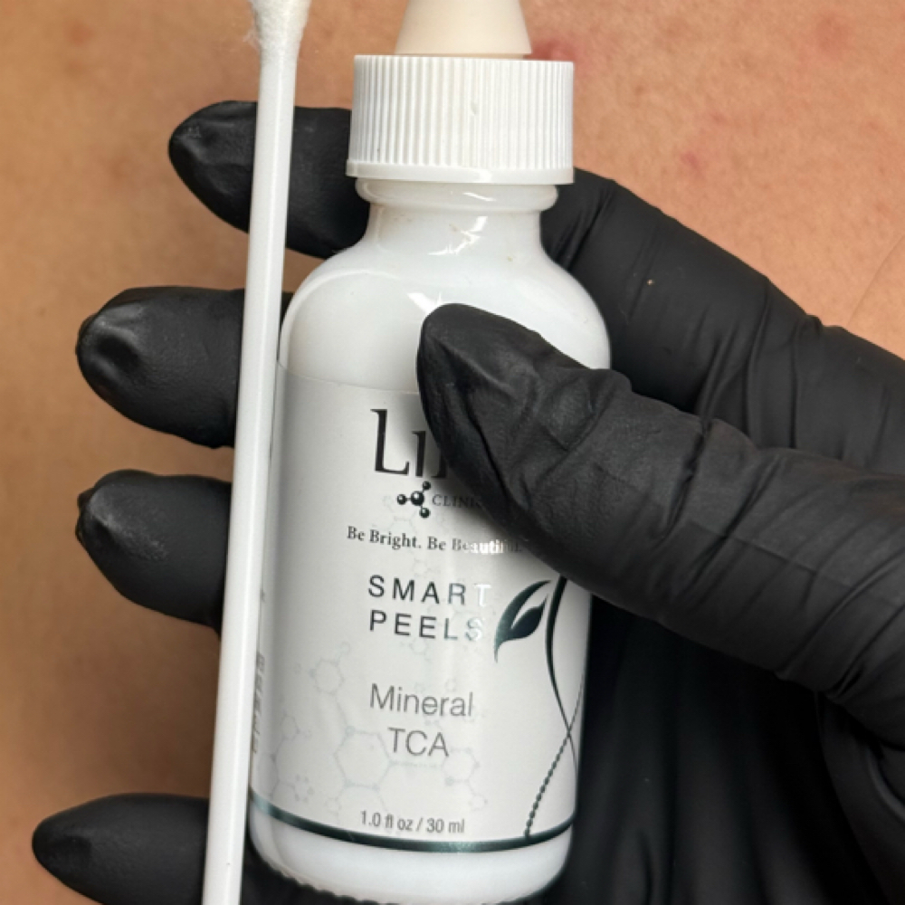 Advanced Chemical Back Peel at Daniela Pimentel in Palm Desert, CA