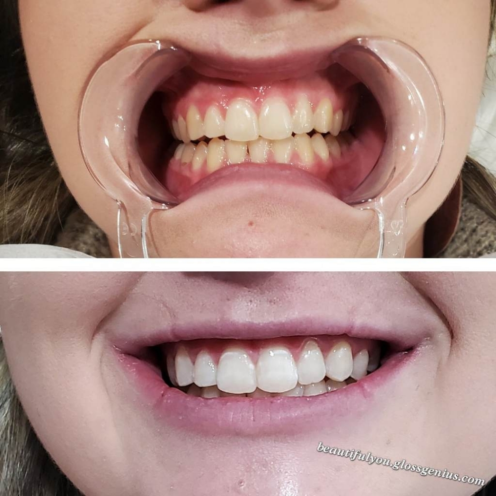 Teeth Whitening