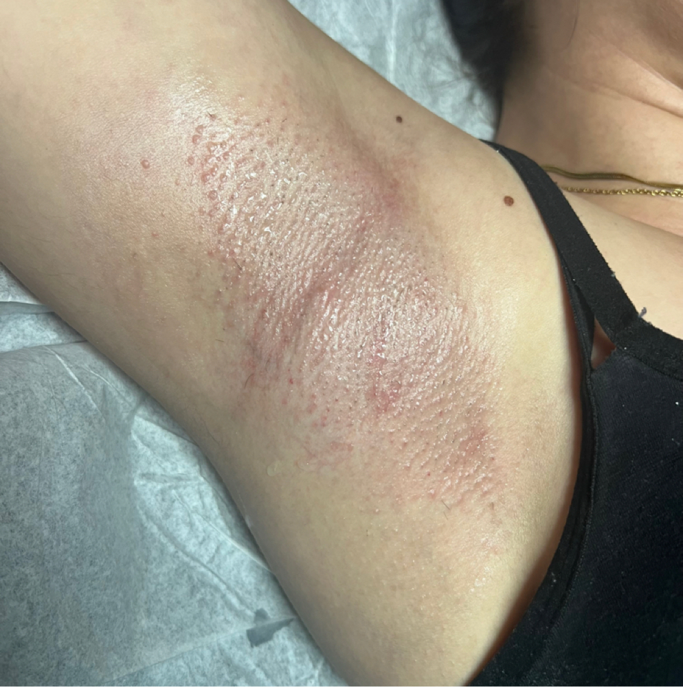 Underarm Wax at Illuminate Dentistry & Aesthetics in St. Joseph, MO