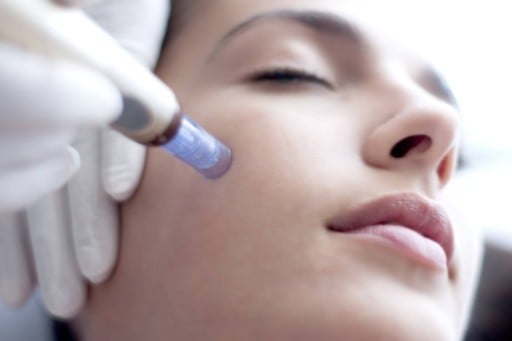 Microneedling