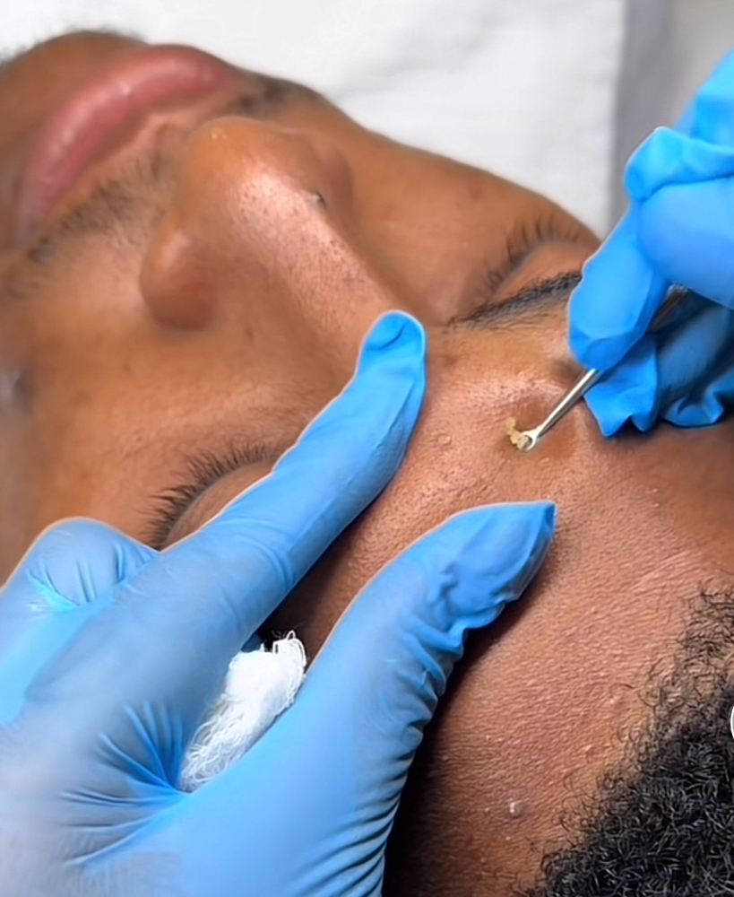 Extractions