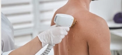 Full Back Laser Hair Removal at M.A.V Aesthetics in Fort Morgan, CO