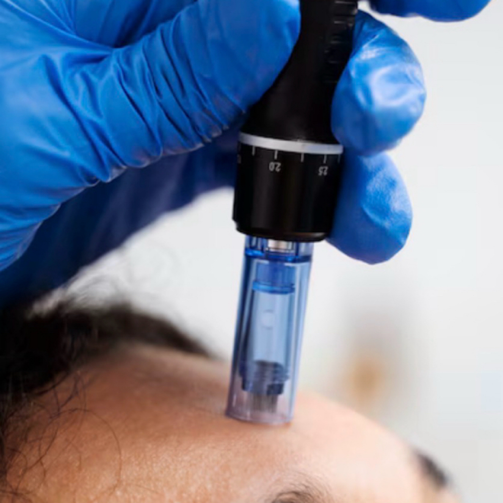 Microneedling at XKIN BEAUTY in McAllen, TX