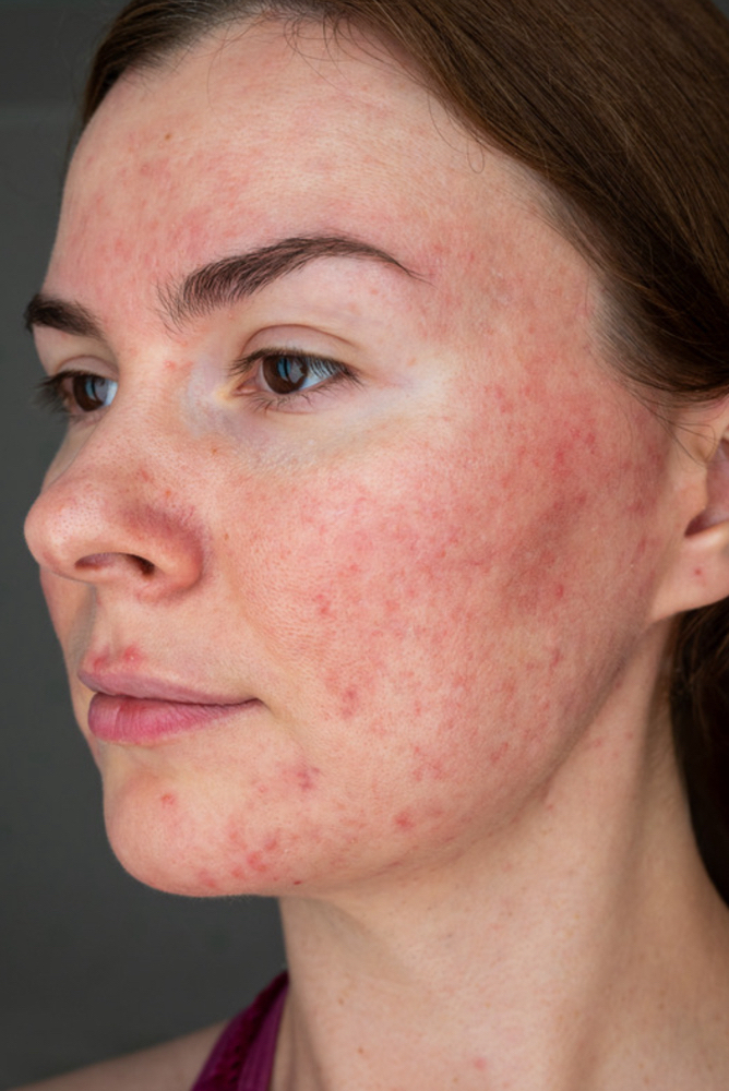 Vein Reduction (Rosacea)