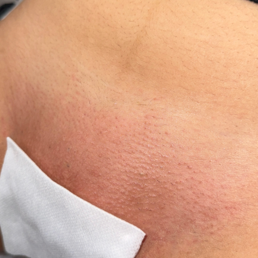 Brazilian Wax at SimplyEsthetics in Glenarden, MD