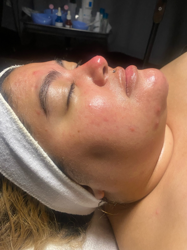 Oxygen Facial