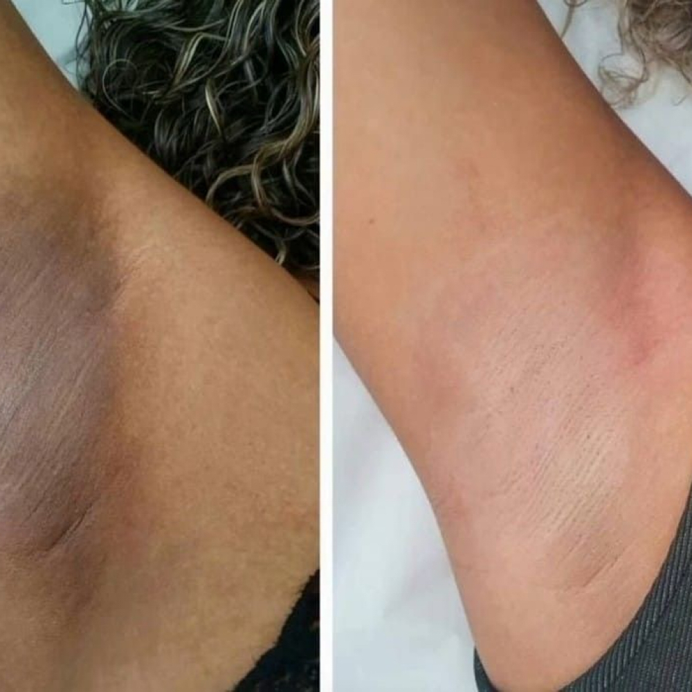 Carbon Laser Underarm Whitening at Alexthetics Beauty Studio in New York, NY