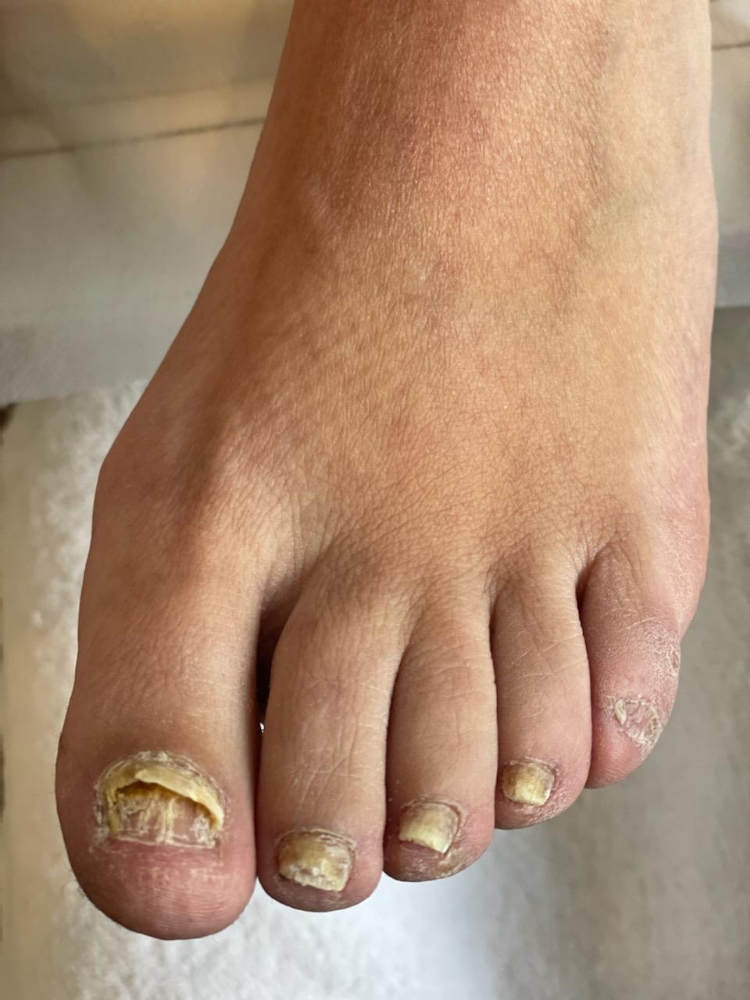 Waterless Pedi/Toenail Restoration