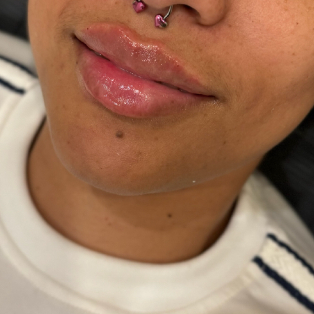 Lip Filler at U•Glow by Laura Mesa in Tampa, FL