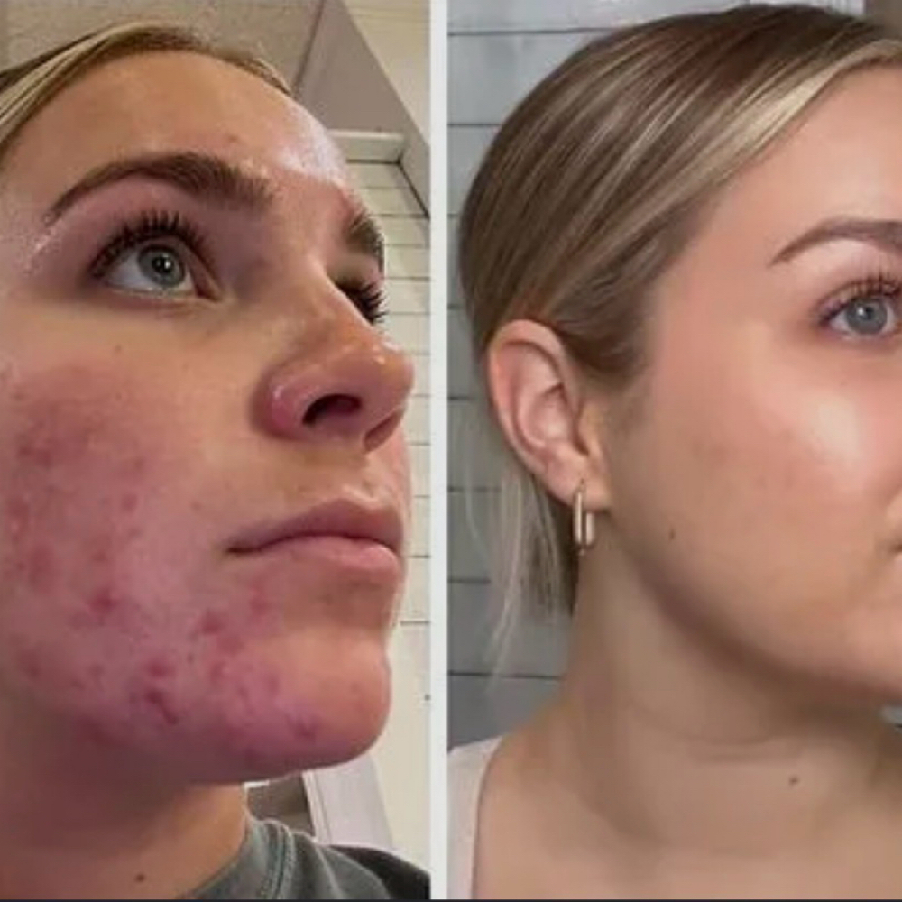 Acne Clearing Program -Face Reality at Rejuva Glow Beauty in Bethesda, MD