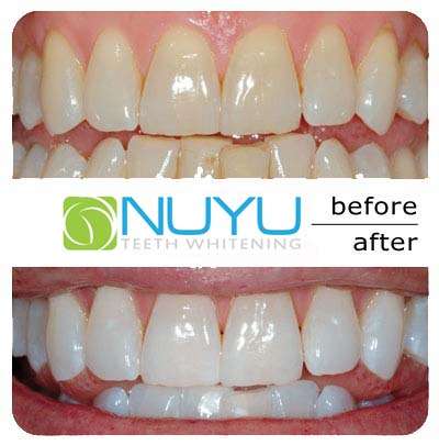 30 Minute Teeth Whitening