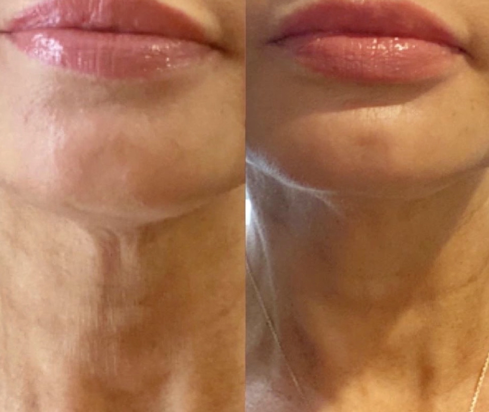 MICRONEEDLING NECK ADD ON