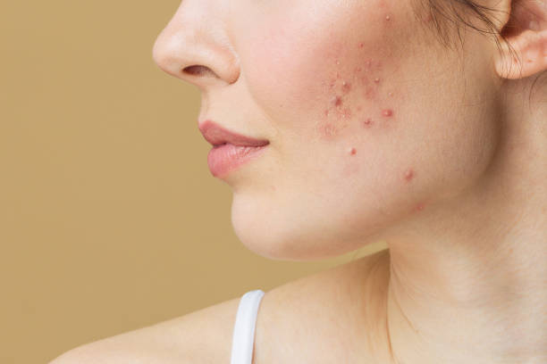 Laser Acne Spot Treatment