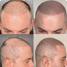 Scalp Micropigmentation (SMP)