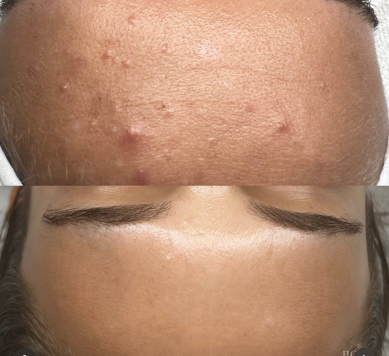 CLEAR + CALM TREATMENT