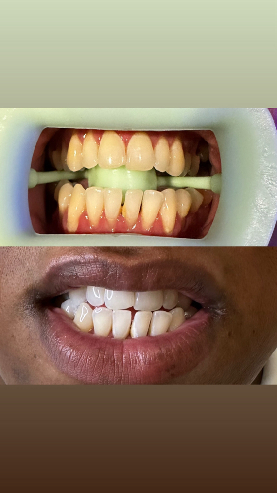 Luxury Teeth Whitening