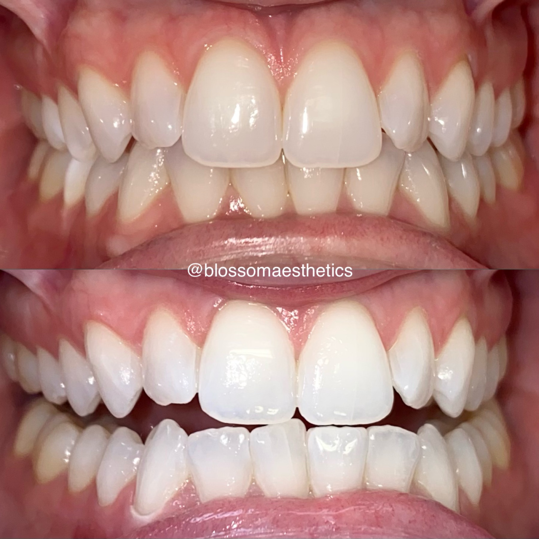 One Hour Teeth Whitening