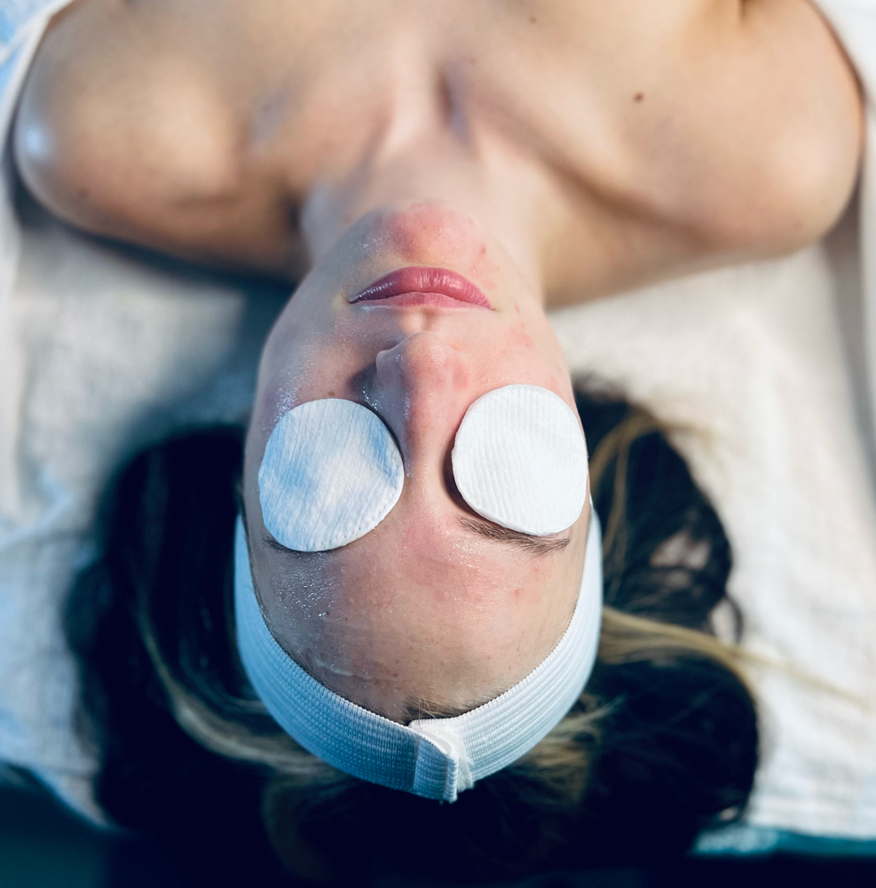Acne Facial