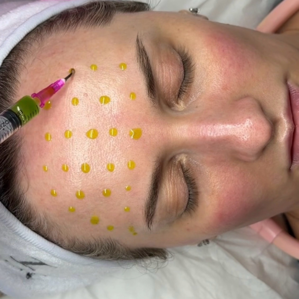 BioRepeel Facial at Marta Rabelo Skin & Laser in Malden, MA