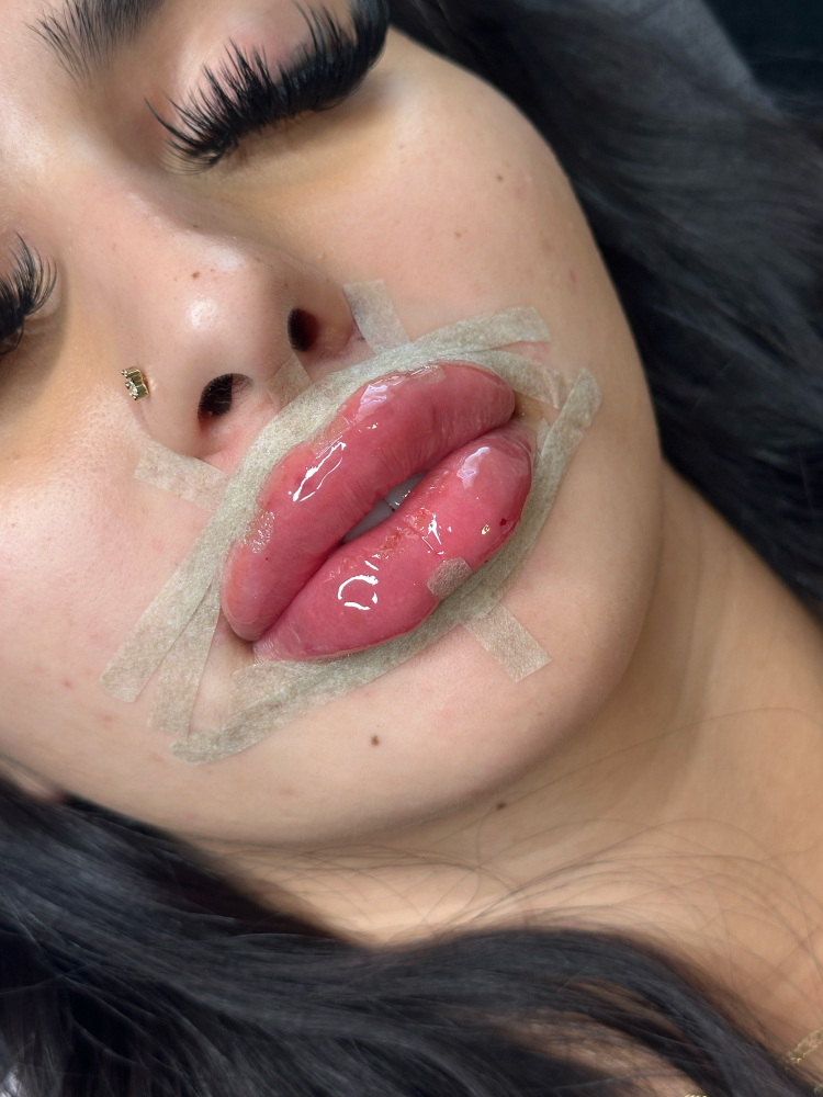 Strip Lip Technique