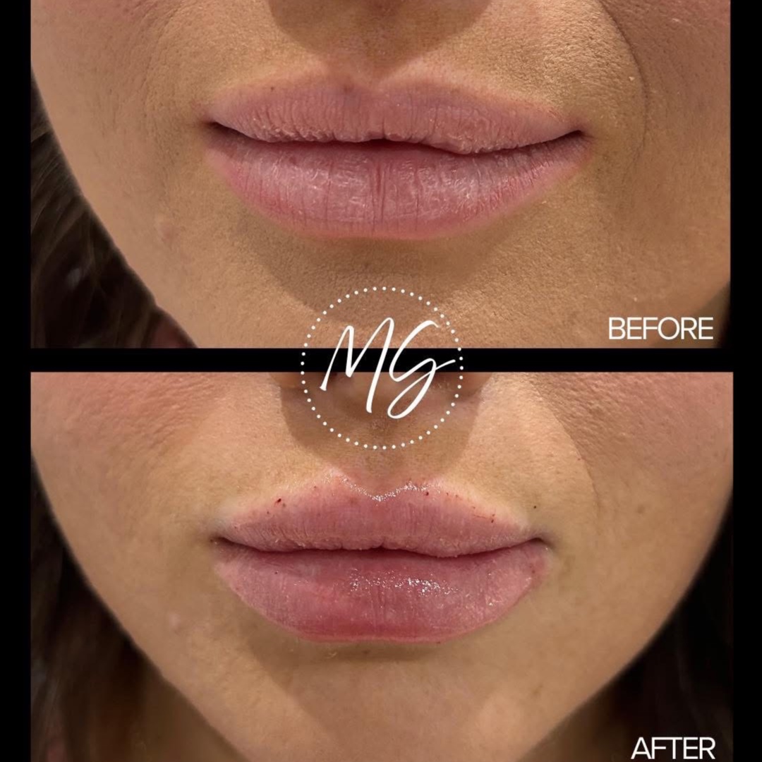 Lip Filler at Barnstar Aesthetics in Mocksville, NC