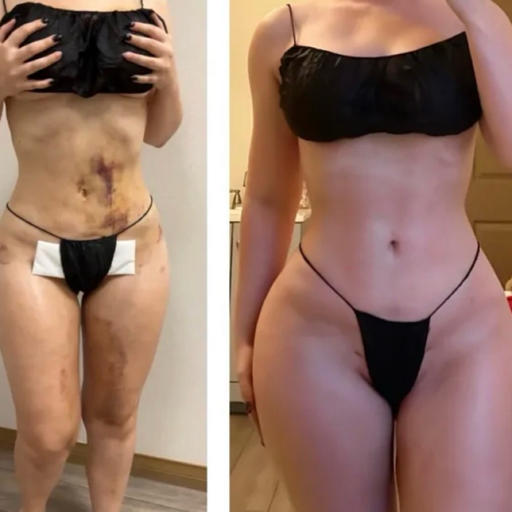 Post-Op Care at Sculpting Beauty by Pam LLC in Atascocita, TX