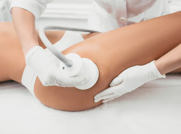 Body Contouring - Cavitation Only