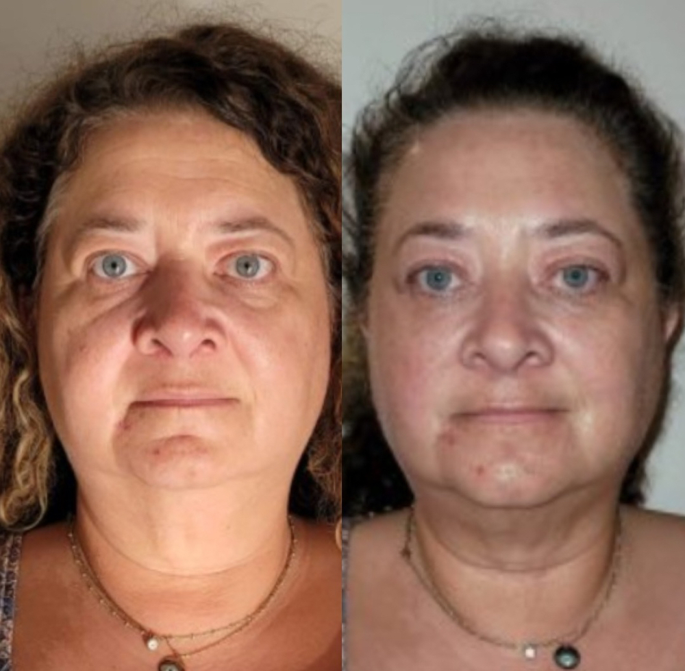 Multi Modality Anti-Aging treatment