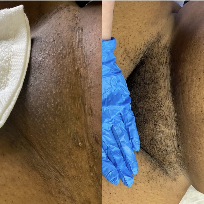 Brazilian Wax