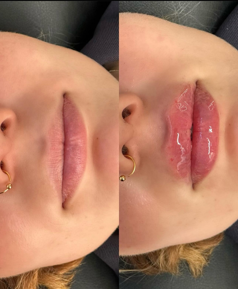 Hylauron Pen Lip Fillers