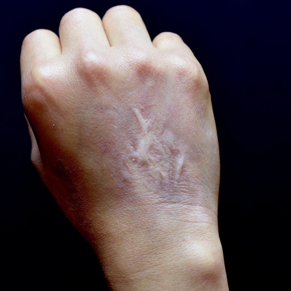 Burn Scar Revision at Pamper Me Ink  Paramedical Tattooing in Tucson, AZ