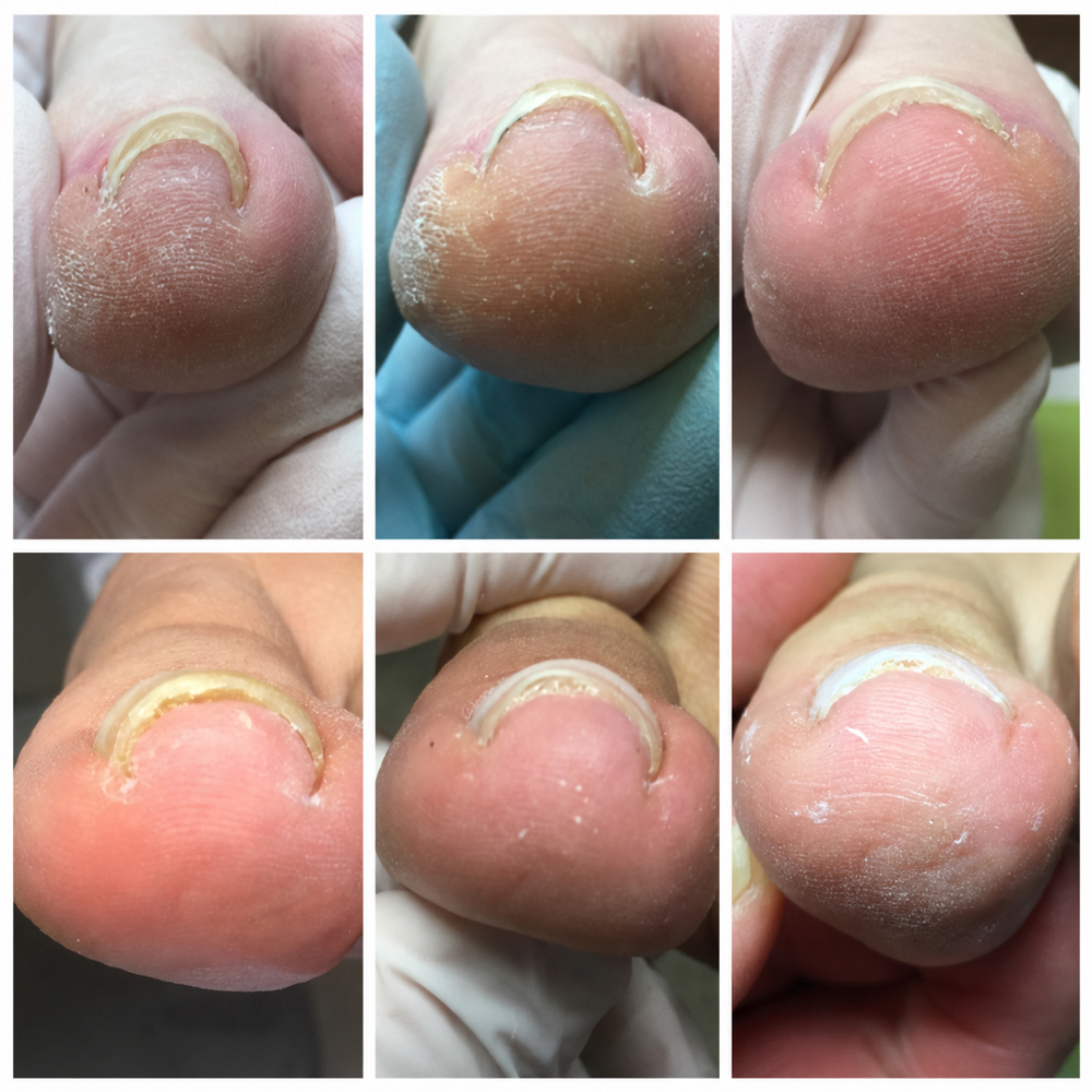 ONYFIX NAIL CORRECTION at MNB SALONS LLC in San Antonio, TX