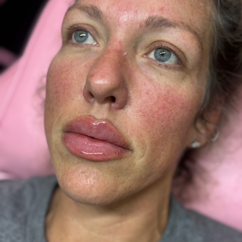 JUNE LIP FILLER SPECIAL at The Skin Room Aesthetic and Wellness LLC in Longview, TX