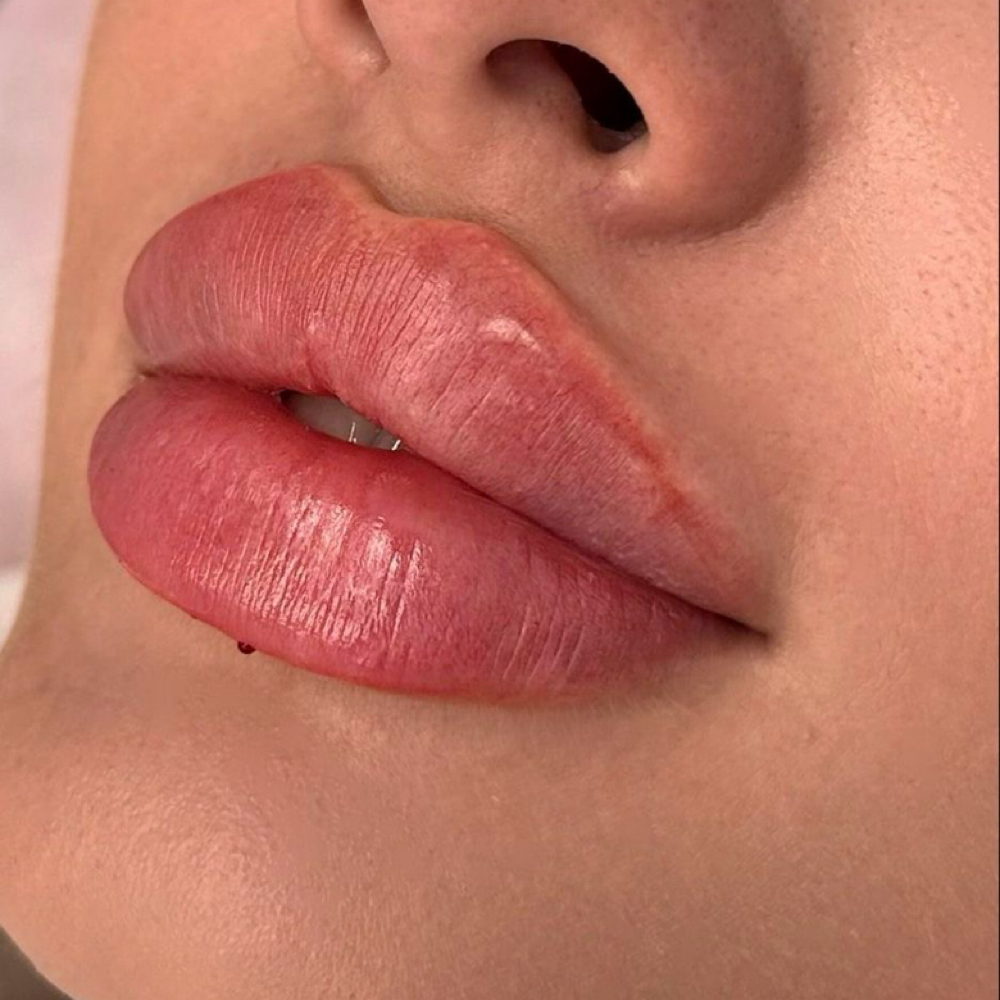 AUGUST LIP FILLER SPECIALS at The Skin Room Aesthetic and Wellness  LLC in Longview, TX