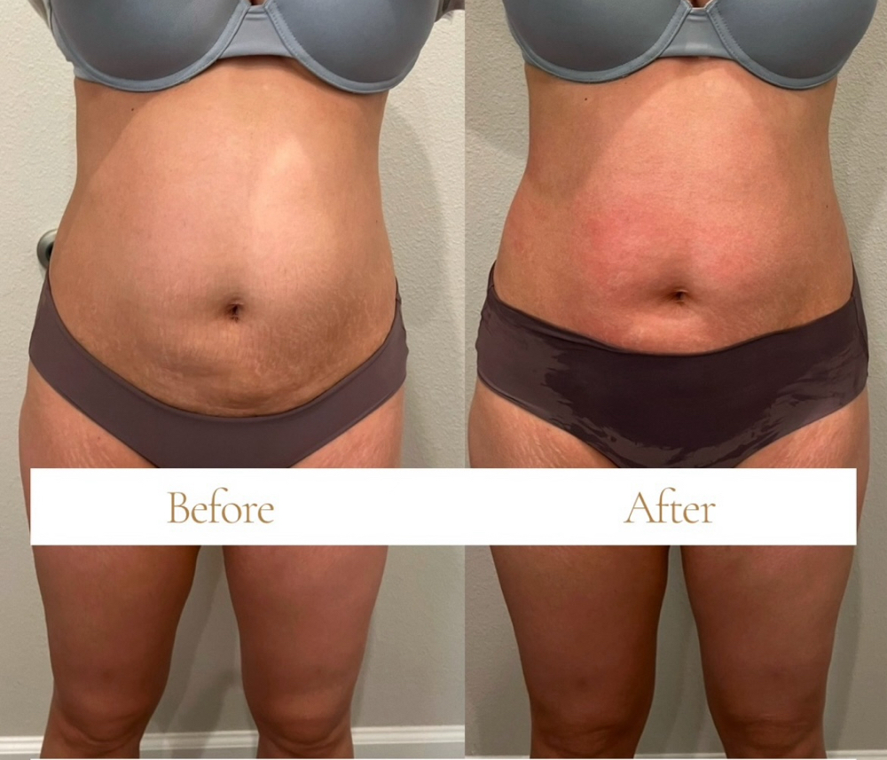 Mommy Makeover Treatment at Blossom Vanity Spa in Missouri City, TX