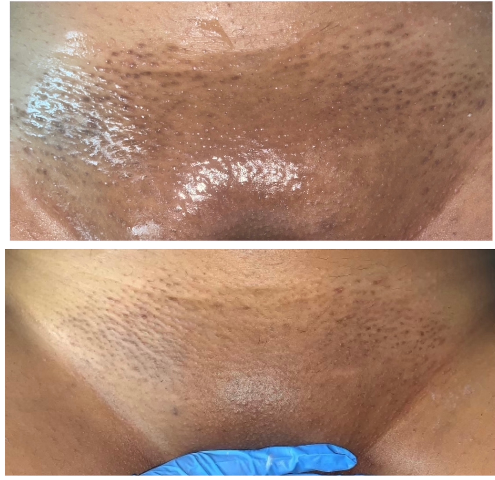 Brazilian Wax