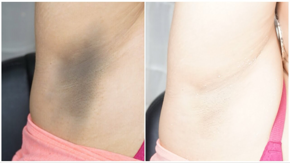 Underarm Whitening