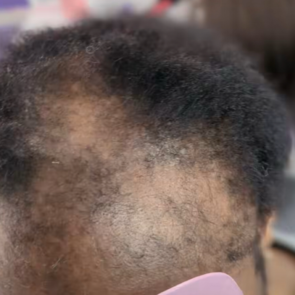 Alopecia at Queen of knotless‼️👑 in Warren, MI