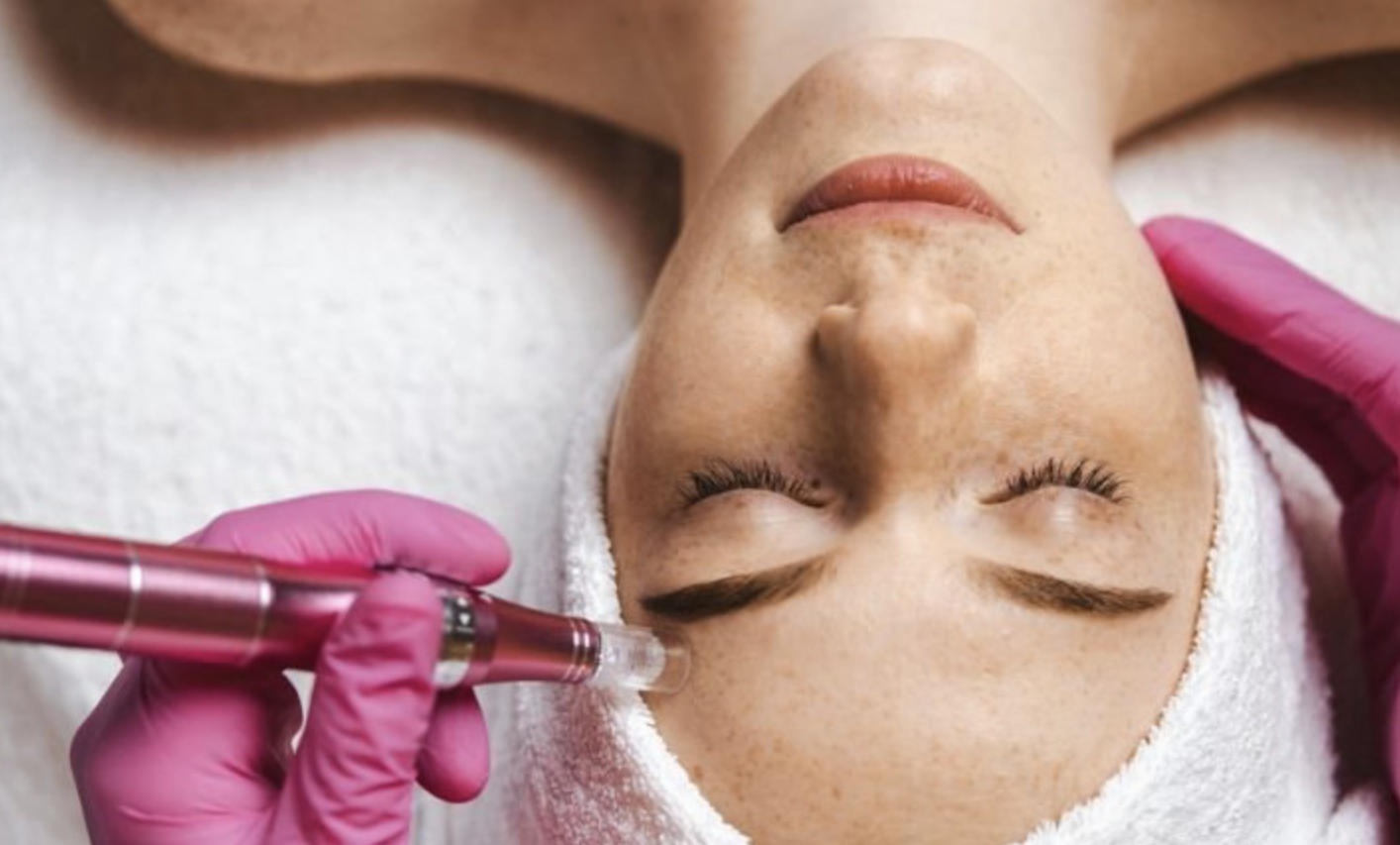 The Glacial Rebuild Microneedling