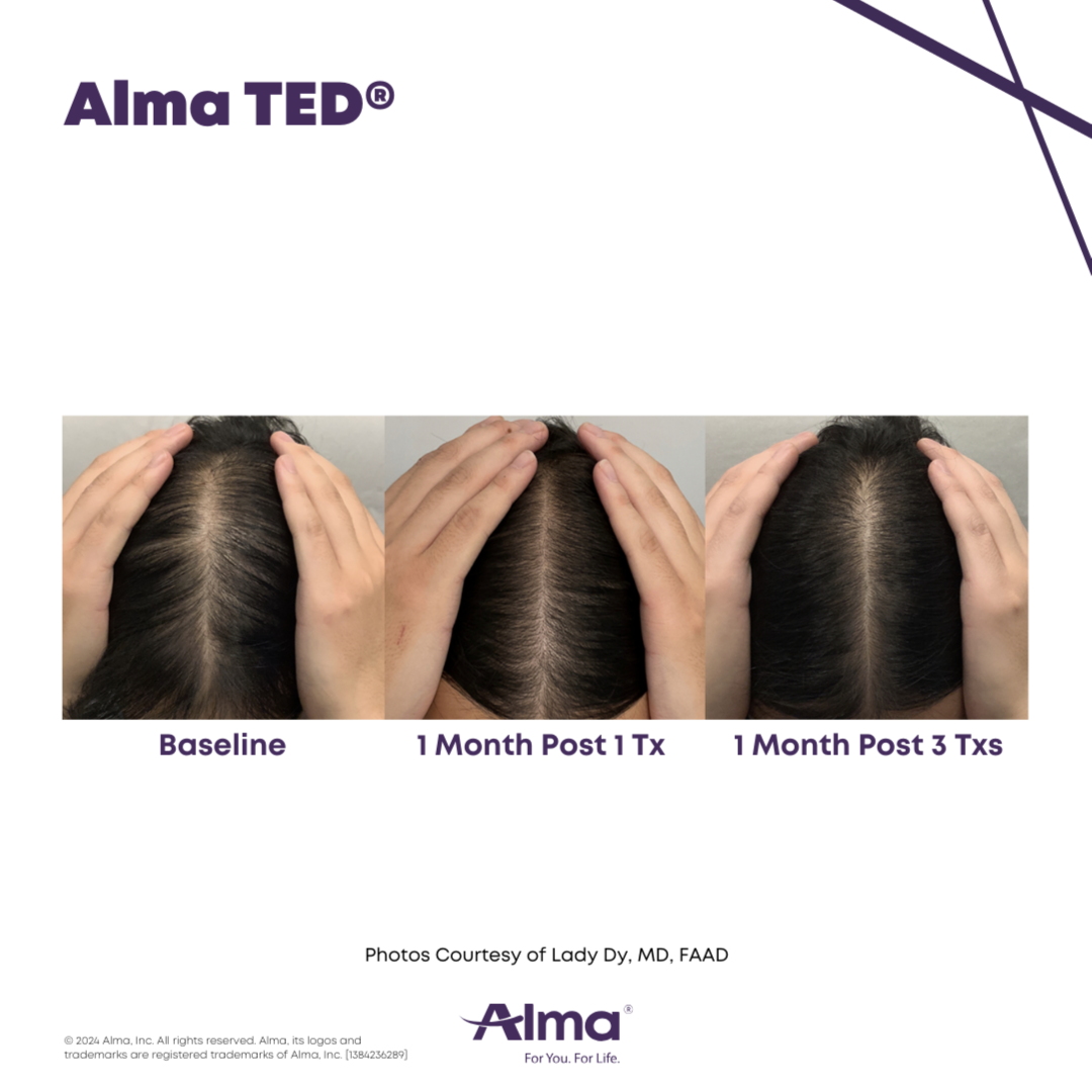 AlmaTED® - Hair Restoration