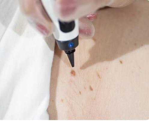 Dark Spot/ Sun Spot Removal