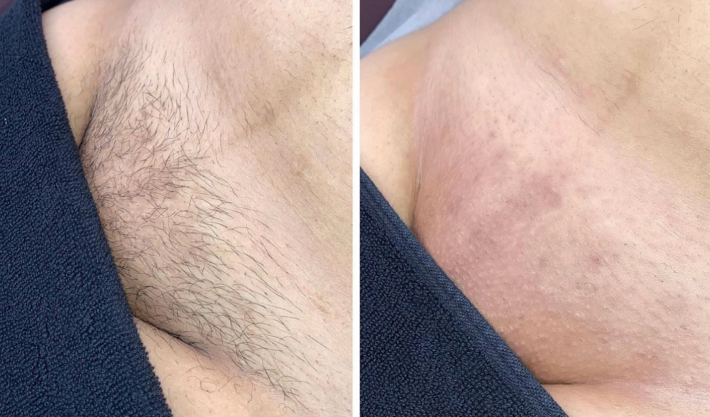 Brazilian Waxing ($55)